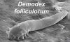 Demodex Mites: Linking Them to Chronic Dry Eye Issues