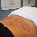 Sports Recovery Acupuncture: 6 Key Benefits to Explore