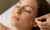 Cosmetic Acupuncture: Important Drawbacks to Know