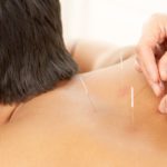Acupuncture and Cupping for Effective Sports Recovery