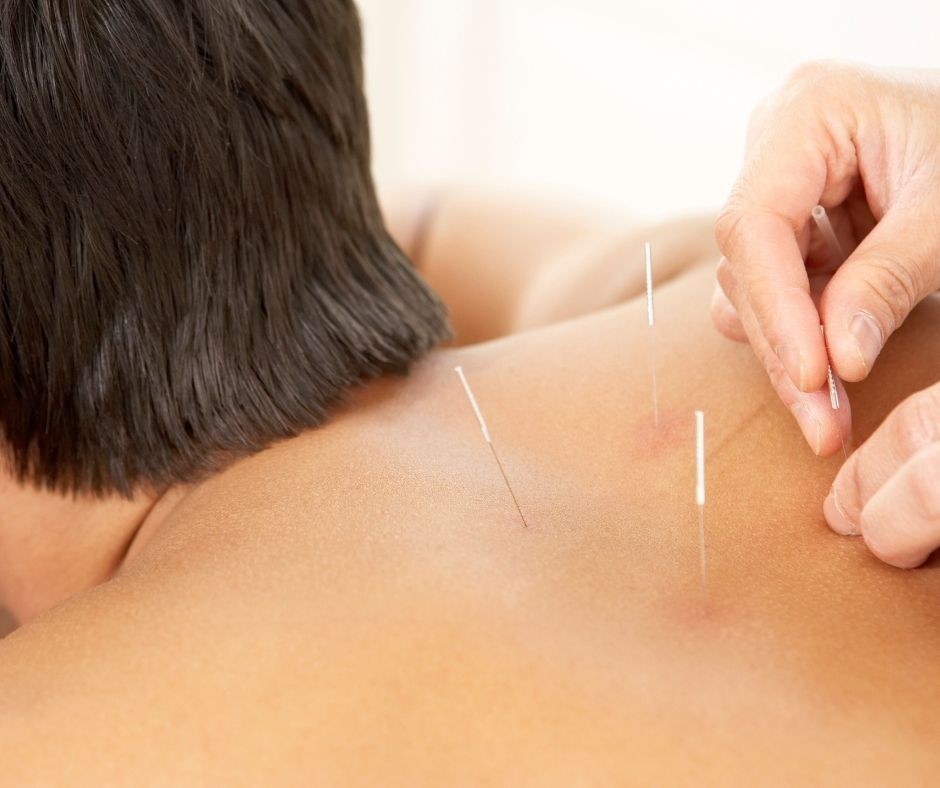 Acupuncture and Cupping for Effective Sports Recovery
